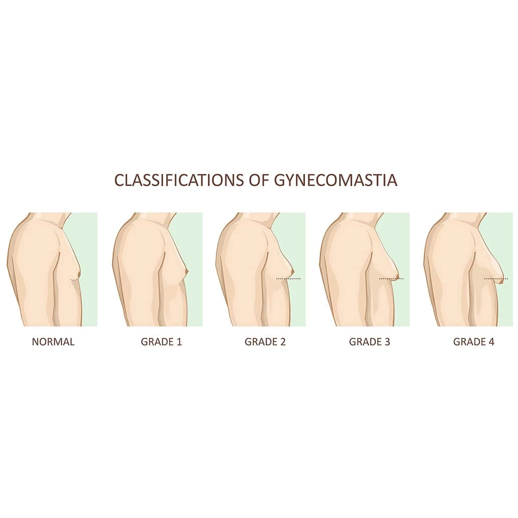 Gynecomastia Gynecomastia