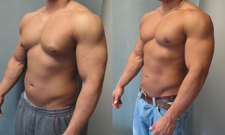 gynecomastia